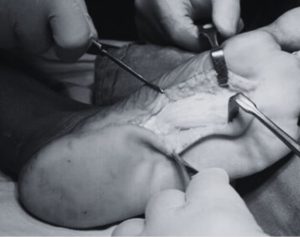 Excision of Plantar Fibroma