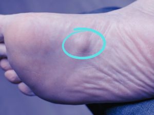 How to Cure Plantar Fibroma