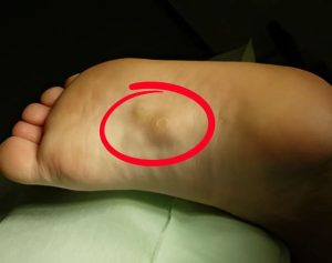 Plantar Fibroma Massage