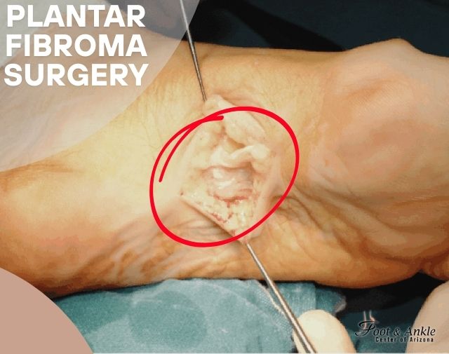 Plantar Fibroma Surgery