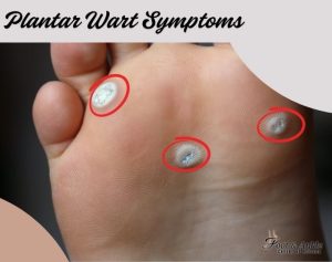Plantar Wart Symptoms