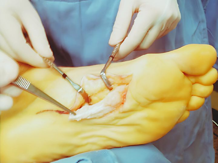 Is Plantar Fibroma Surgery Painful