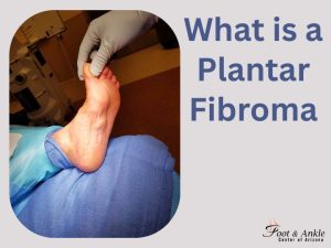what is a plantar fibroma