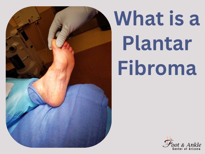 what is a plantar fibroma