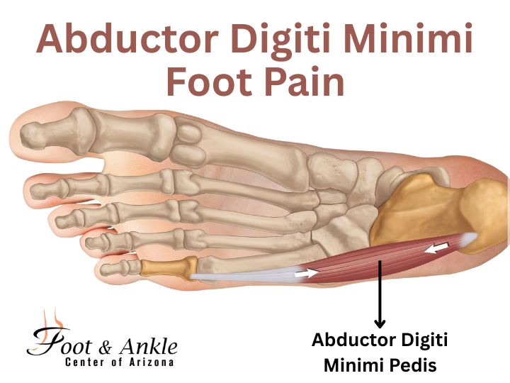 Abductor Digiti Minimi Foot Pain