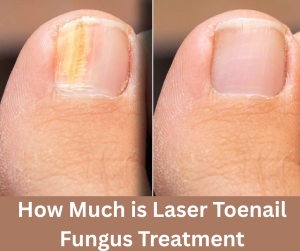How Much is Laser Toenail Fungus Treatment