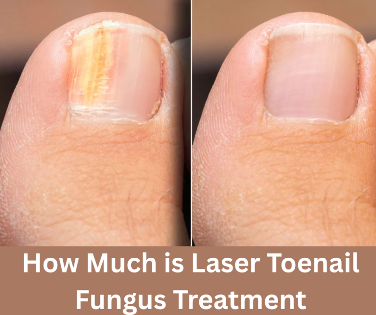 How Much is Laser Toenail Fungus Treatment