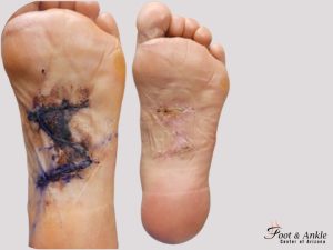 How long is Recovery from Plantar Fibroma Surgery