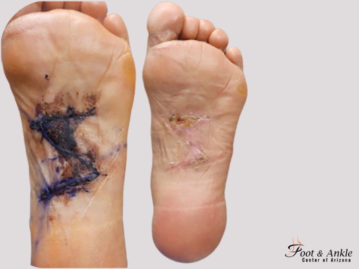 How long is Recovery from Plantar Fibroma Surgery
