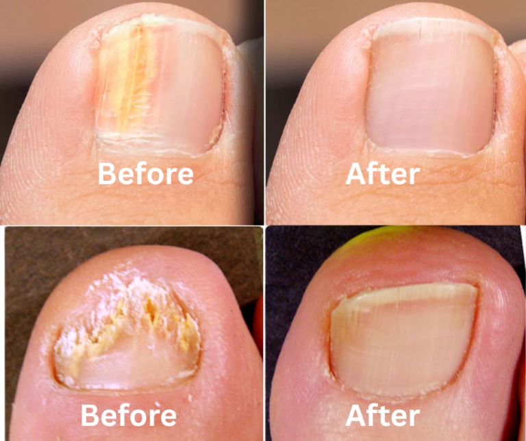 Toenail Fungus Laser Treatment Before and After