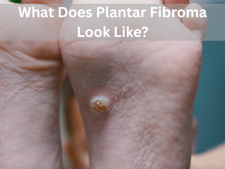 What Does Plantar Fibroma Look Like