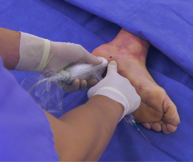 long-term effects of plantar fasciitis surgery