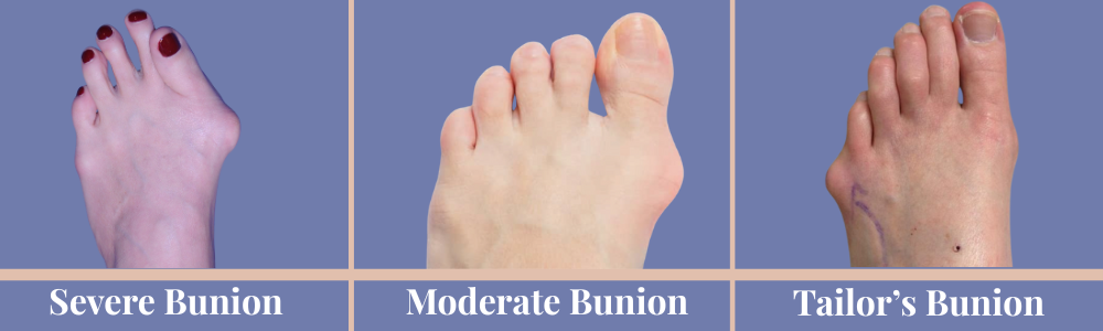Type of Buniion