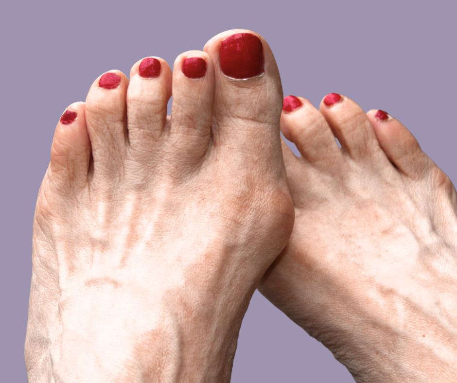Bunion Treatment