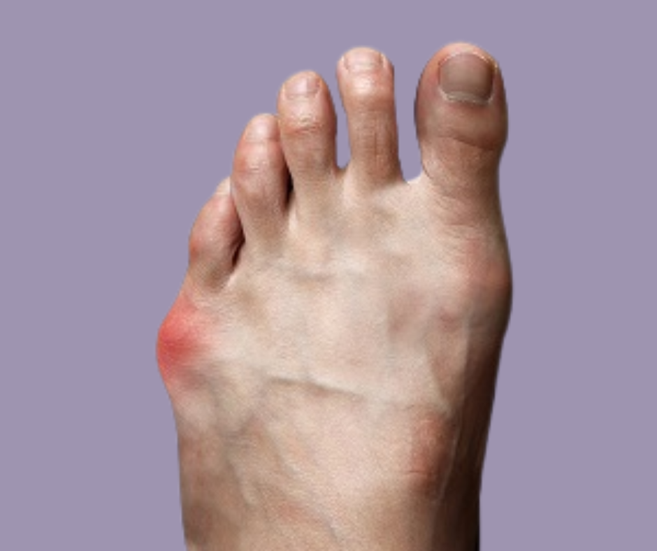 Bunionette Deformity
