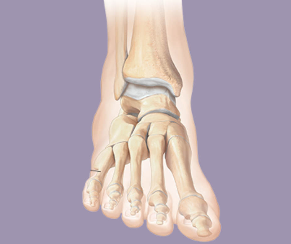 Metatarsal Fracture