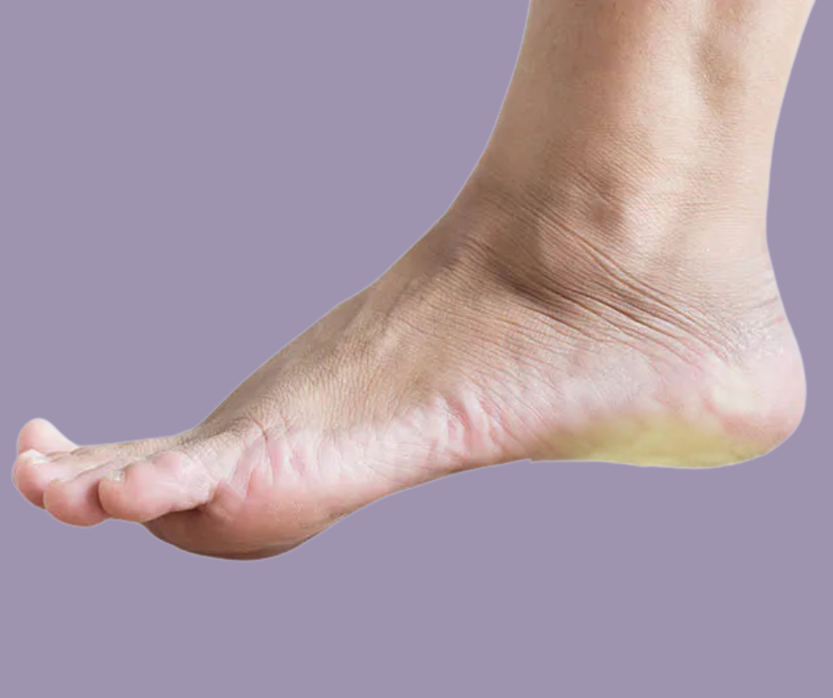Plantar Fasciitis