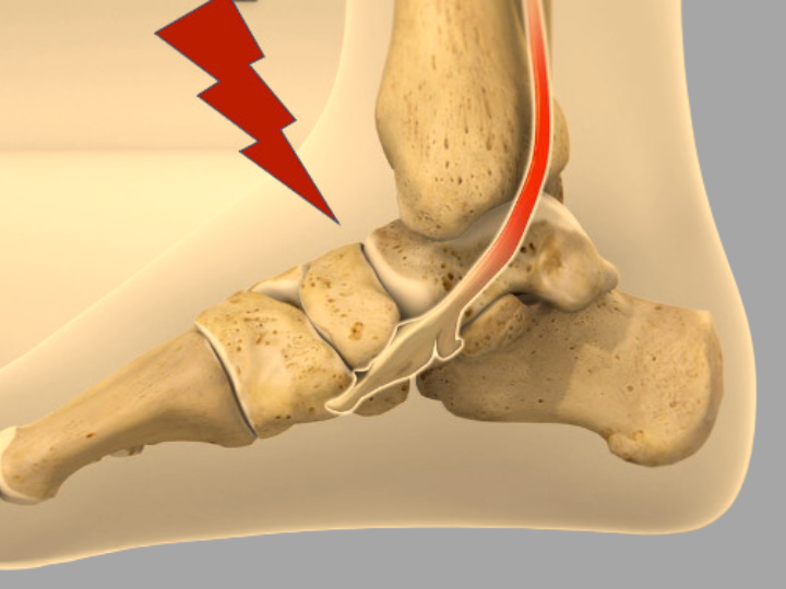 anterior ankle impingement