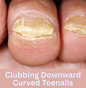Clubbing Downward Curved Toenails