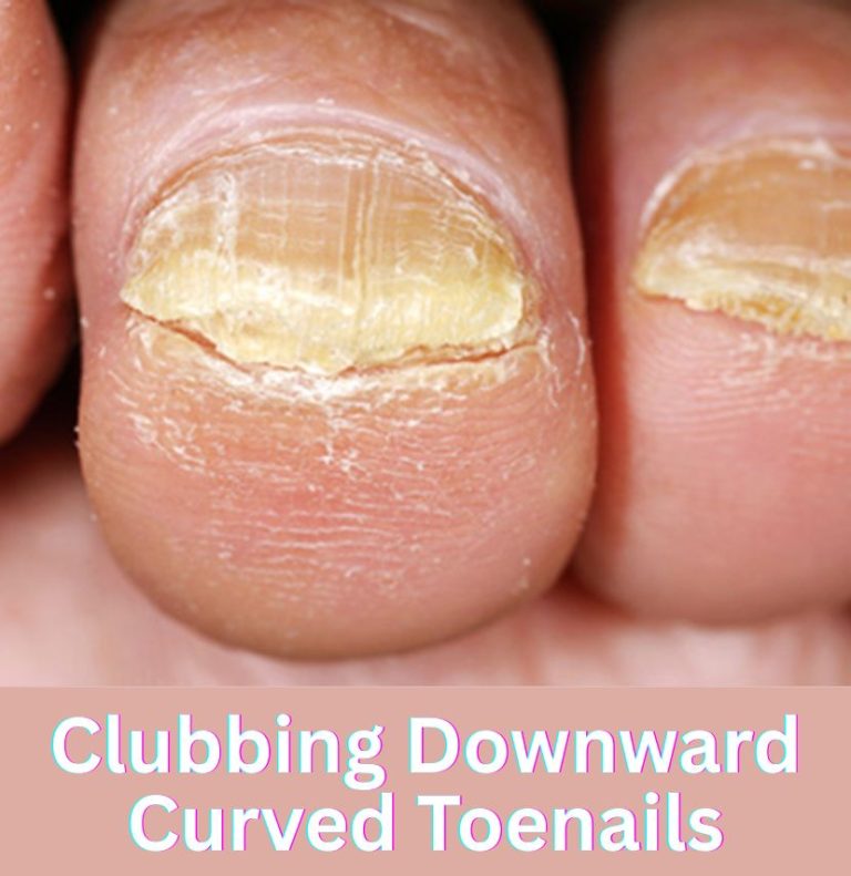 Clubbing Downward Curved Toenails