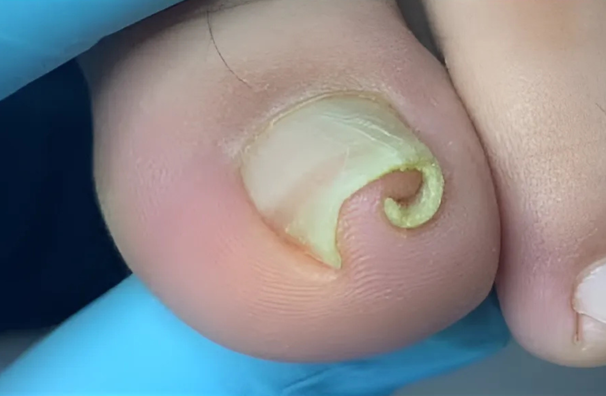 Curved Toenails in Scottsdale, AZ