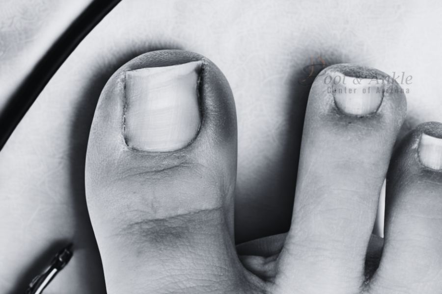 How to Straighten Curved Toenails