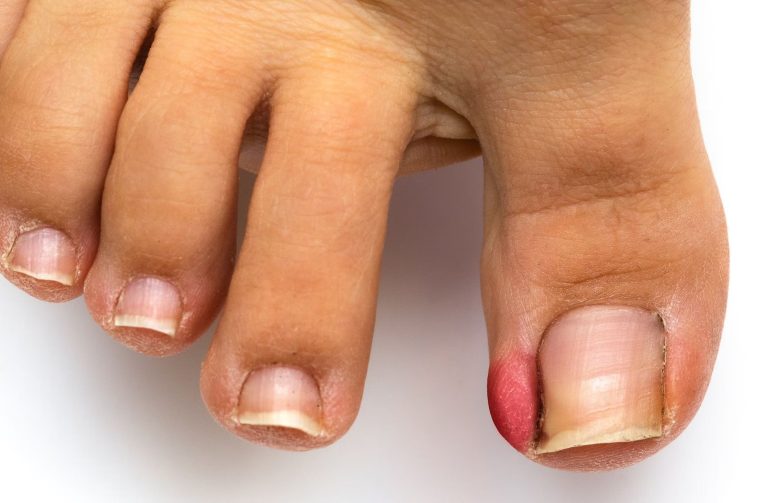 How to Straighten Curved Toenails