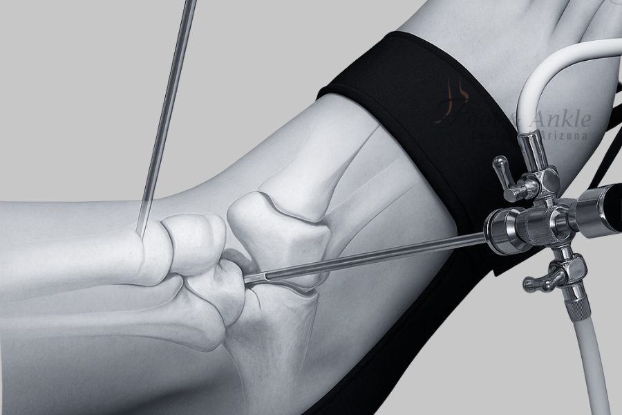 Ankle Arthroscopy