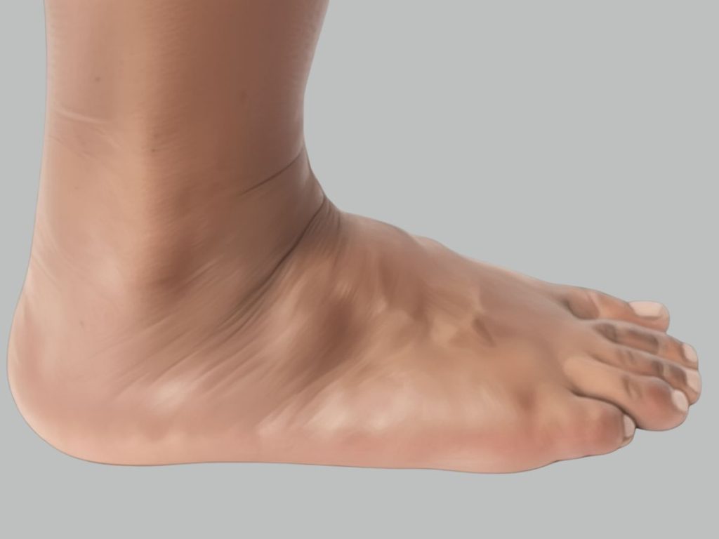 Ganglion Cyst Foot