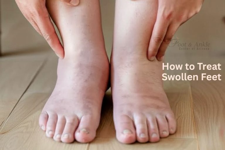 How to Treat Swollen Feet