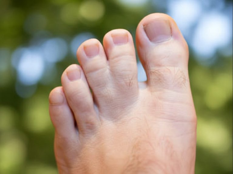 How Common Is Webbed Toes