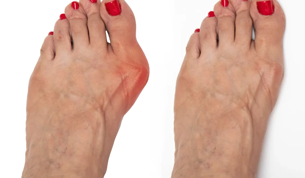 Bunion Surgery